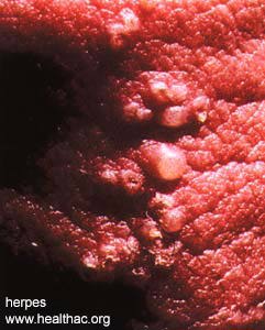 herpes genital picture symptom simplex virus pic photo 