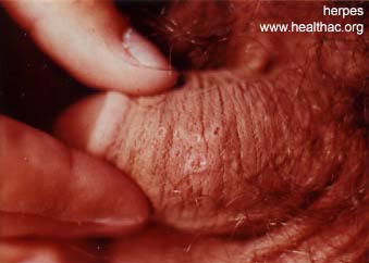 herpes genital picture symptom simplex virus pic photo 