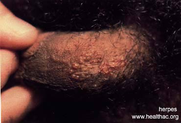 herpes genital picture symptom simplex virus pic photo 