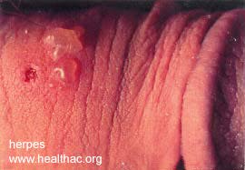 herpes genital picture symptom simplex virus pic photo 