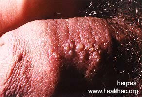 herpes genital picture symptom simplex virus pic photo 