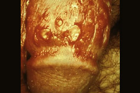 herpes genital picture symptom simplex virus pic photo 