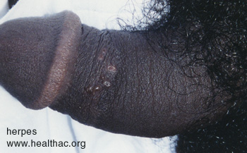 herpes genital picture symptom simplex virus pic photo 