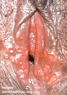 herpes genital picture symptom simplex virus pic photo 