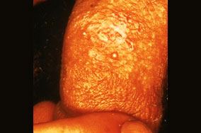 herpes genital picture symptom simplex virus pic photo 