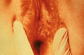 herpes genital picture symptom simplex virus pic photo 