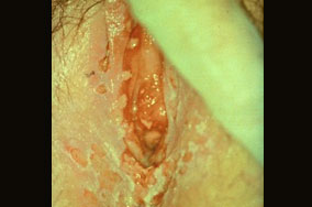 herpes genital picture symptom simplex virus pic photo 