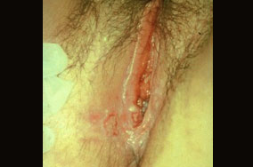 herpes genital picture symptom simplex virus pic photo 