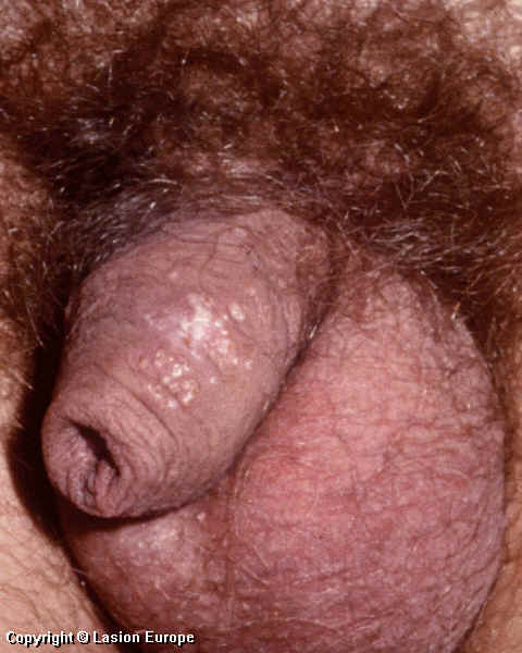 herpes genital picture symptom simplex virus pic photo 