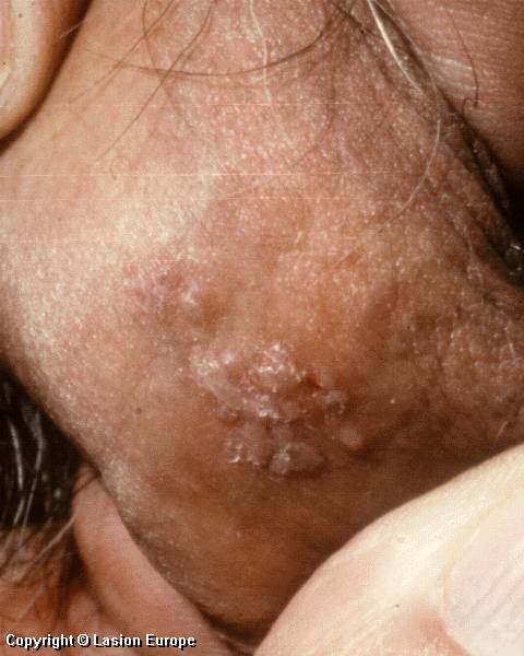 herpes genital picture symptom simplex virus pic photo 