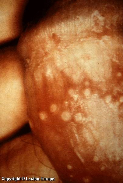 herpes genital picture symptom simplex virus pic photo 