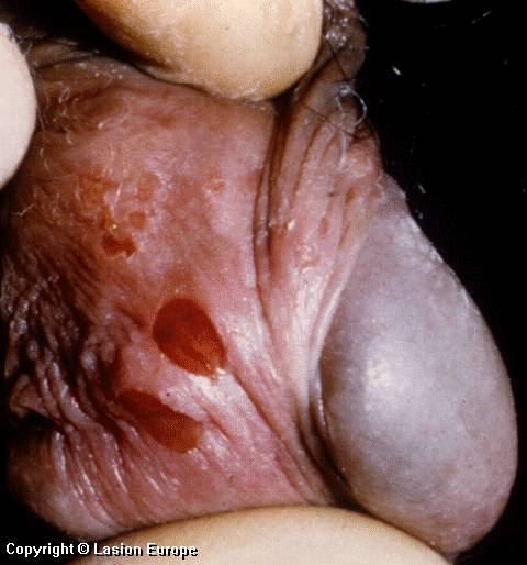 herpes genital picture symptom simplex virus pic photo 