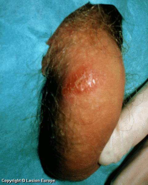 herpes genital picture symptom simplex virus pic photo 