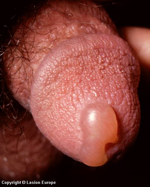 herpes genital picture symptom simplex virus pic photo 