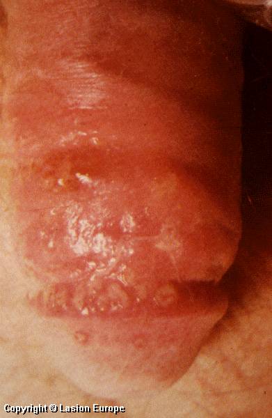 herpes genital picture symptom simplex virus pic photo 