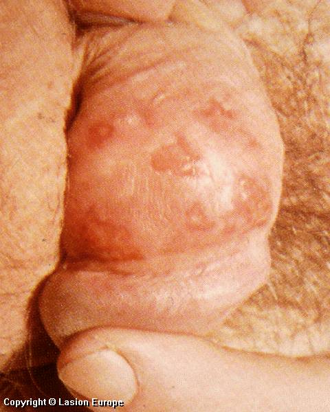 herpes genital picture symptom simplex virus pic photo 