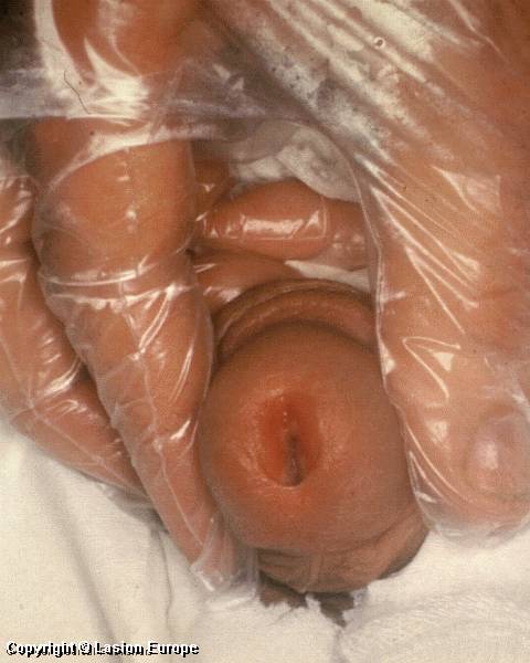 herpes genital picture symptom simplex virus pic photo 