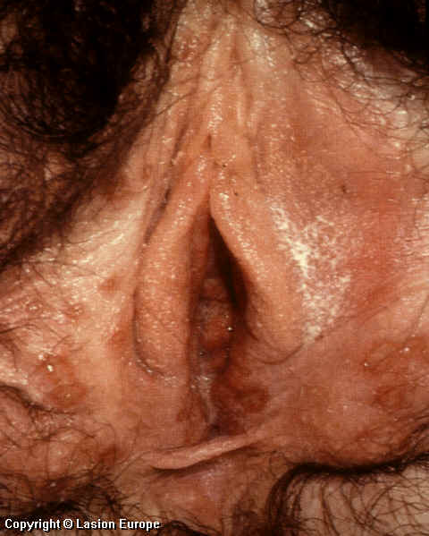 herpes genital picture symptom simplex virus pic photo 