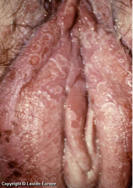 herpes genital picture symptom simplex virus pic photo 