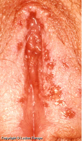 herpes genital picture symptom simplex virus pic photo 