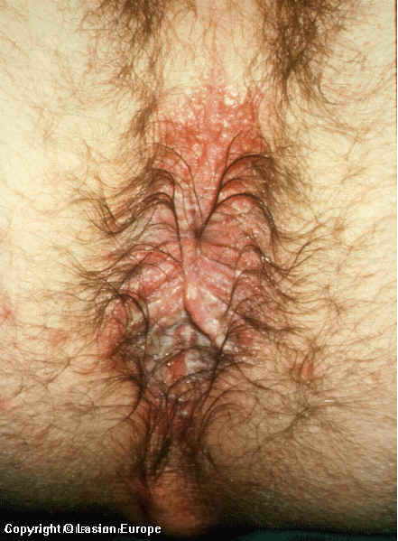 herpes genital picture symptom simplex virus pic photo 