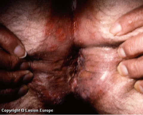 herpes genital picture symptom simplex virus pic photo 