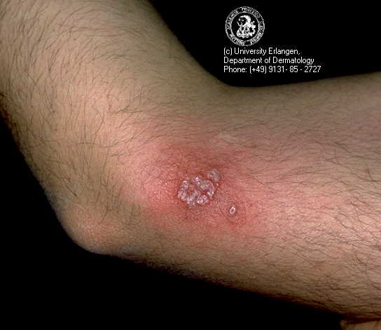 herpes genital picture symptom simplex virus pic photo 