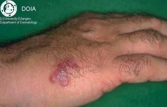 herpes genital picture symptom simplex virus pic photo 