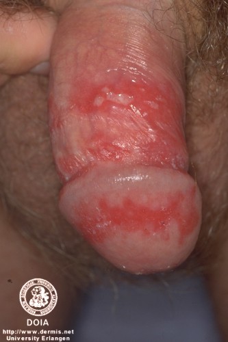 herpes genital picture symptom simplex virus pic photo 