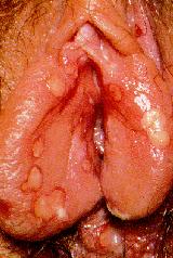 herpes genital picture symptom simplex virus pic photo 