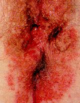 herpes genital picture symptom simplex virus pic photo 