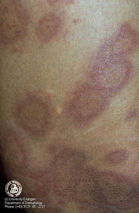 herpes genital picture symptom simplex virus pic photo 