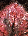 herpes genital picture symptom simplex virus pic photo 