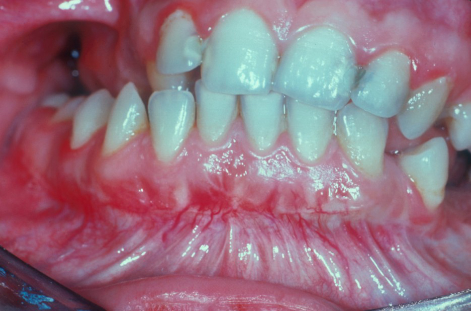 herpes genital picture symptom simplex virus pic photo 