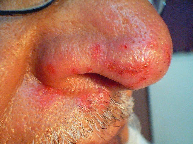 herpes genital picture symptom simplex virus pic photo 