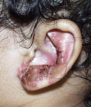 herpes genital picture symptom simplex virus pic photo 