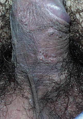 herpes genital picture symptom simplex virus pic photo 