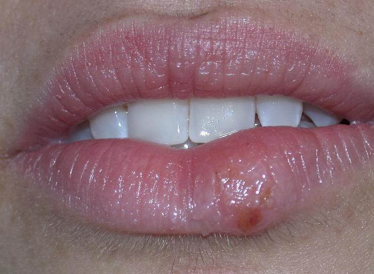 herpes genital picture symptom simplex virus pic photo 