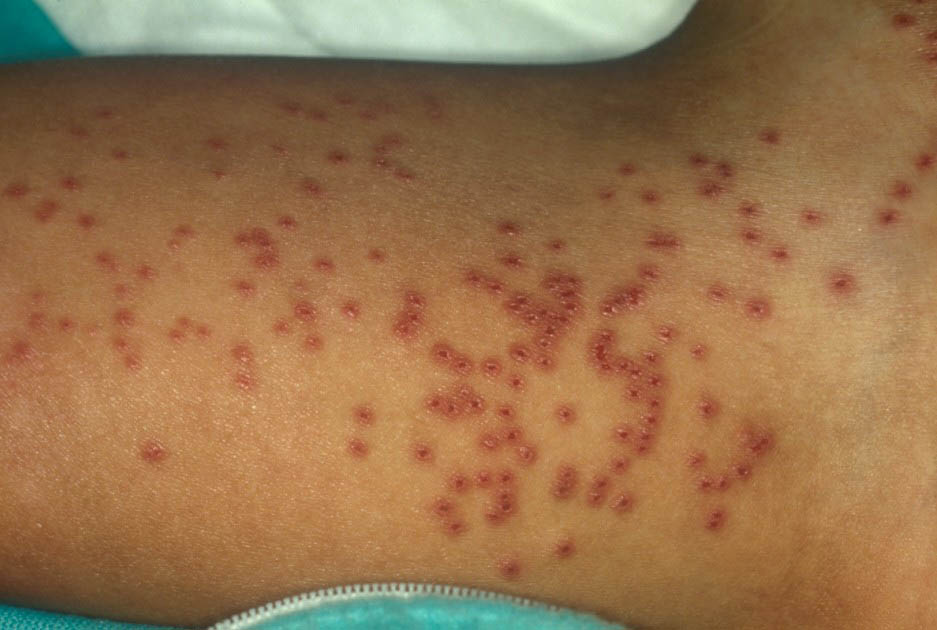 Herpes Buttocks Photos - Dermatology Education