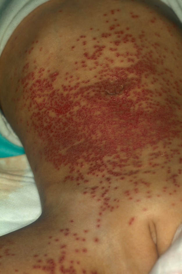 herpes genital picture symptom simplex virus pic photo 