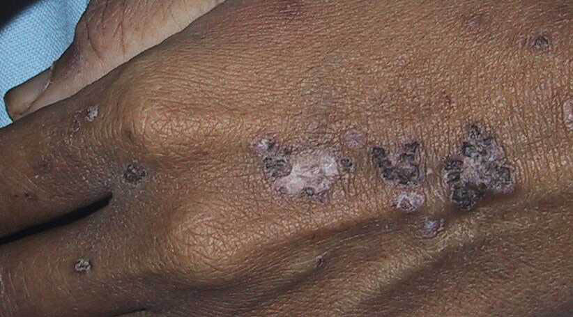 herpes genital picture symptom simplex virus pic photo 