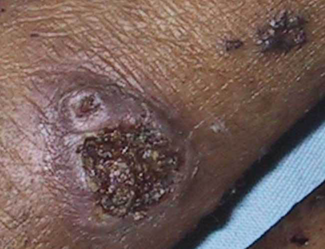 herpes genital picture symptom simplex virus pic photo 