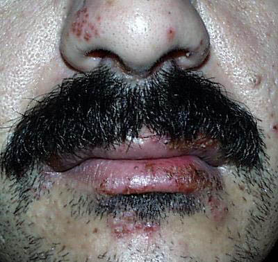 herpes genital picture symptom simplex virus pic photo 