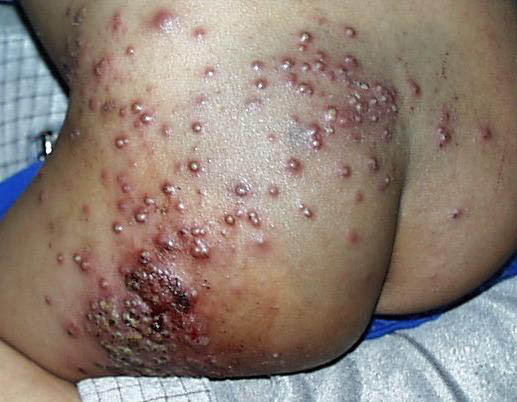 herpes genital picture symptom simplex virus pic photo 