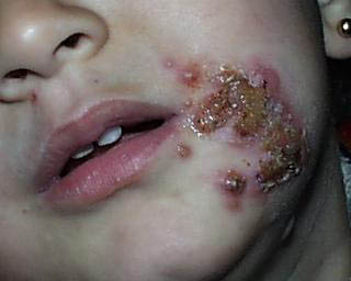 herpes genital picture symptom simplex virus pic photo 