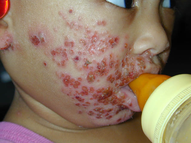 herpes genital picture symptom simplex virus pic photo 