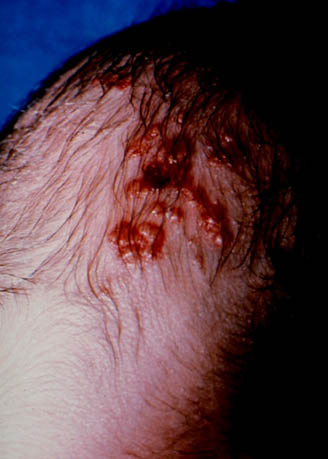 herpes genital picture symptom simplex virus pic photo 