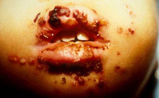 herpes genital picture symptom simplex virus pic photo 