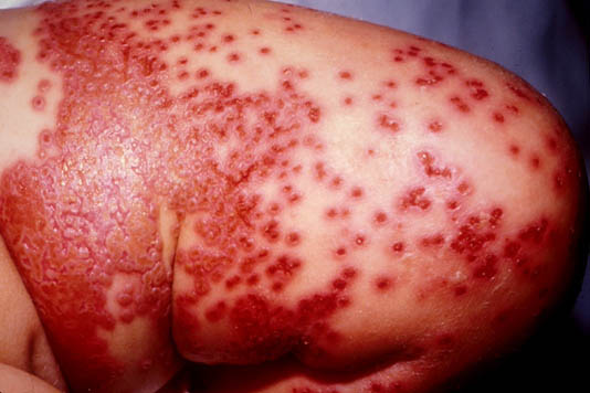 herpes genital picture symptom simplex virus pic photo 