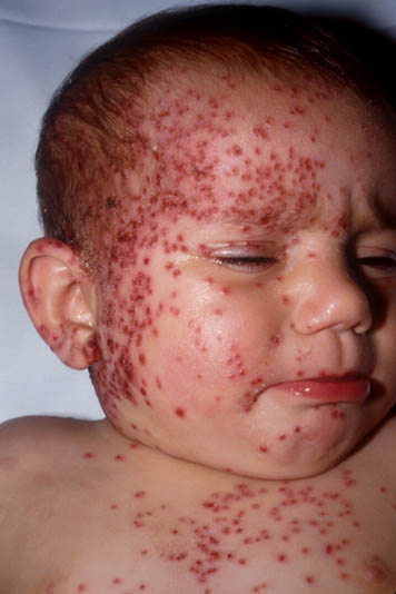 herpes genital picture symptom simplex virus pic photo 